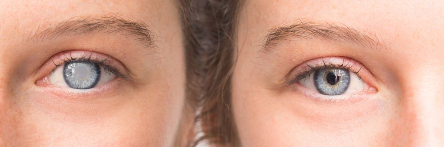 Vergleich gesundes Auge und mit grauem Star