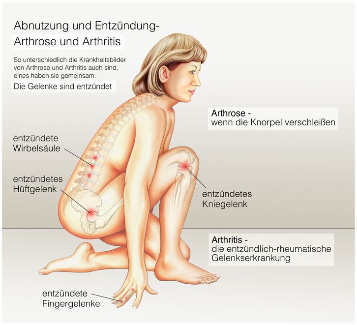 Arthritis und Arthrose