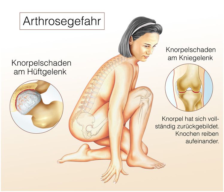 Arthrose im Hüftgelenk und Kniegelenk