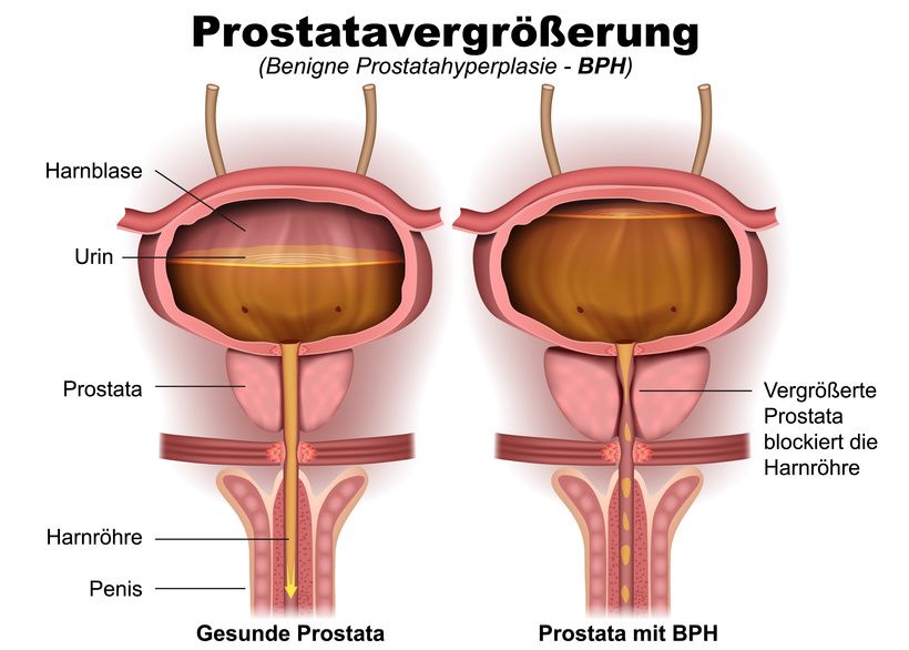 Prostatavergrößerung