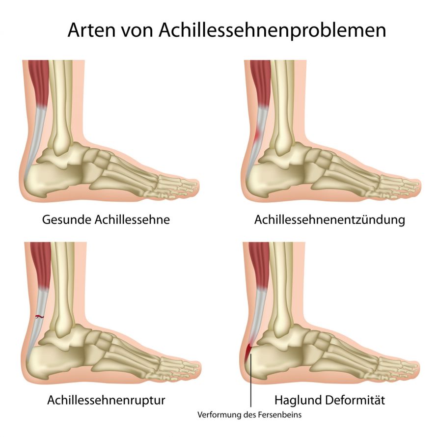 Achillessehnenverletzungen und Haglundferse