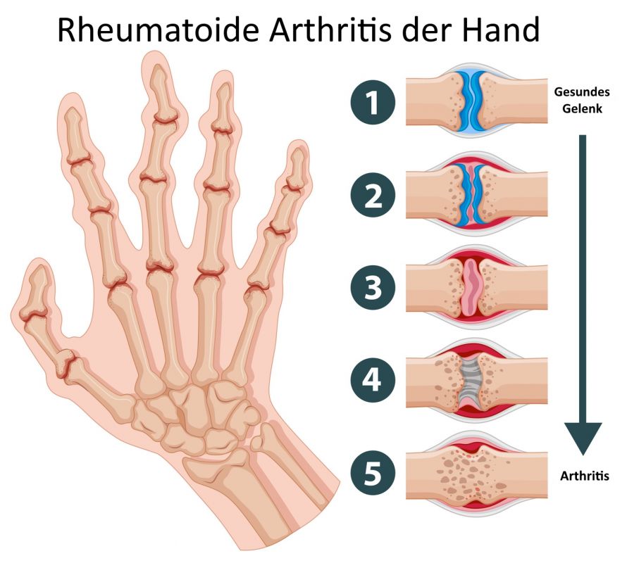 Rheumatoide Arthritis Hand