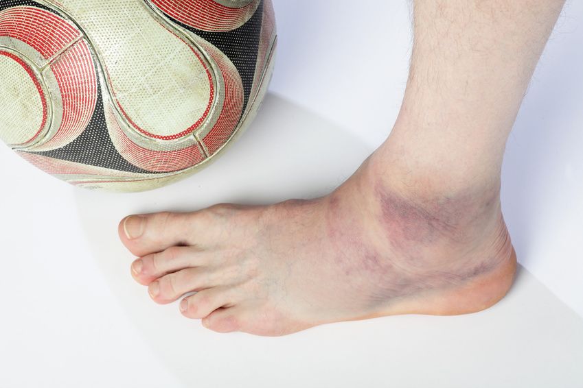 Fußverletzung Schwellung und Bluterguss