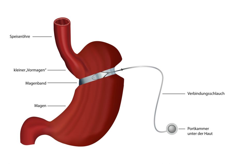 Magenband - Adipositaschirurgie