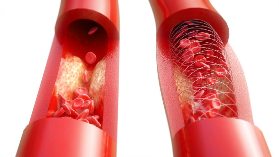 Arterienverengung und Stent