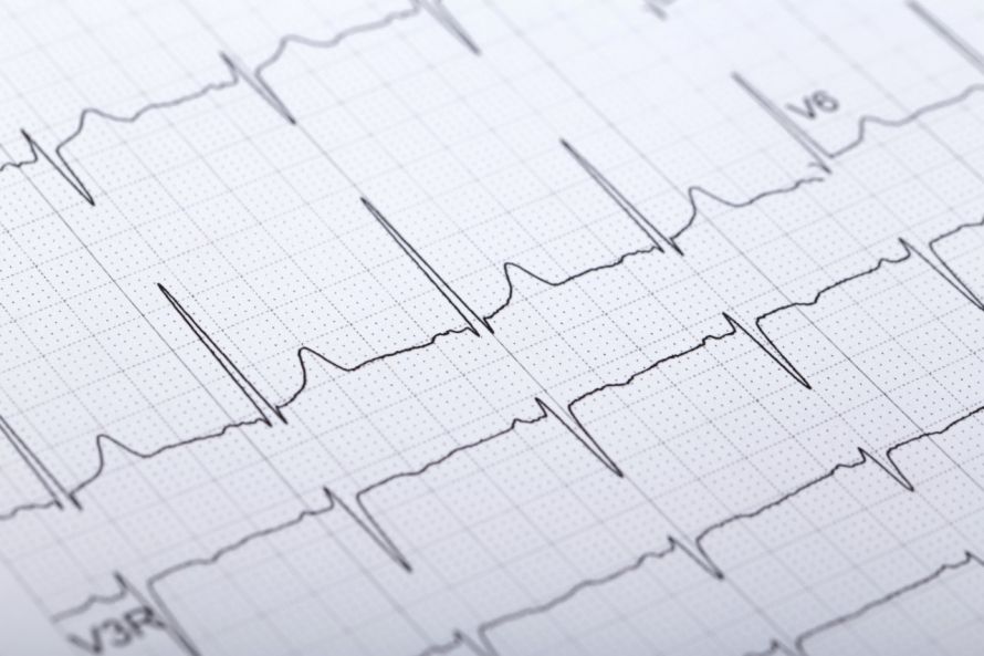 EKG Elektrokardiogramm