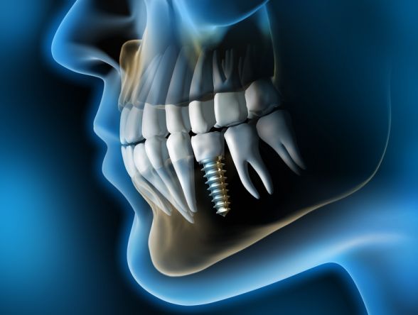 Зубная имплантология