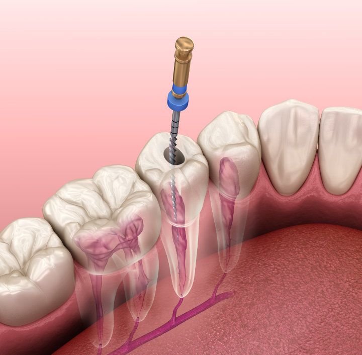 Wurzelkanalbehandlung bzw Endodontie