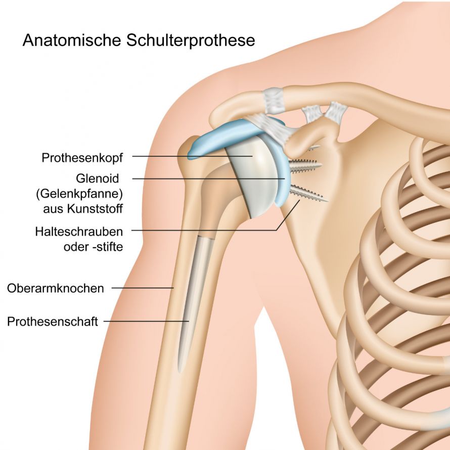 Schulterprothese