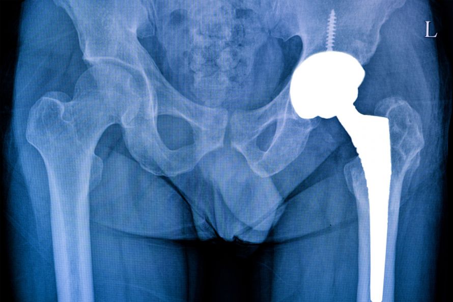 Röntgenbild einer implantierten Hüftprothese
