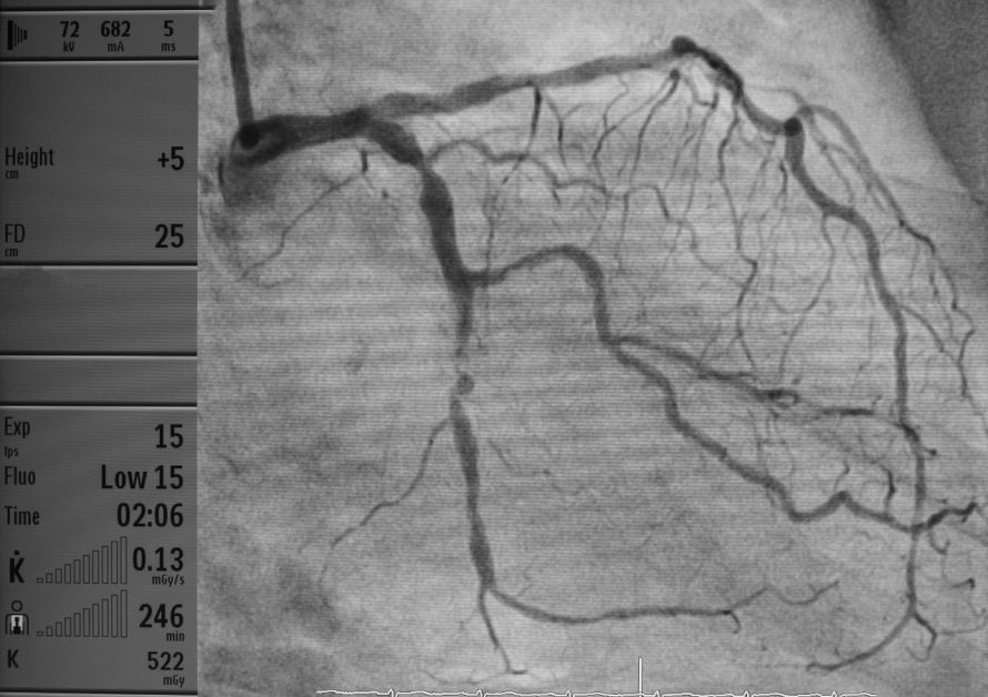 Darstellung der Herzkranzarterien während einer Angiographie