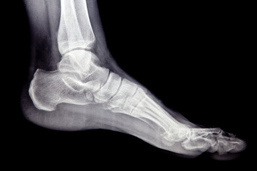 Fuß im Röntgenbild