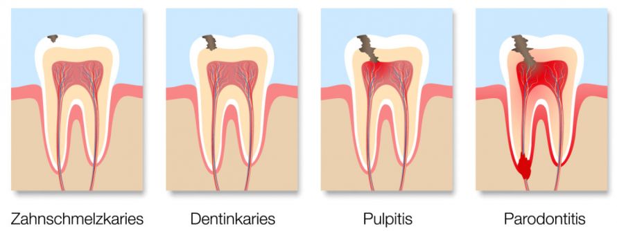 Die Entwicklung von Karies im Zahn