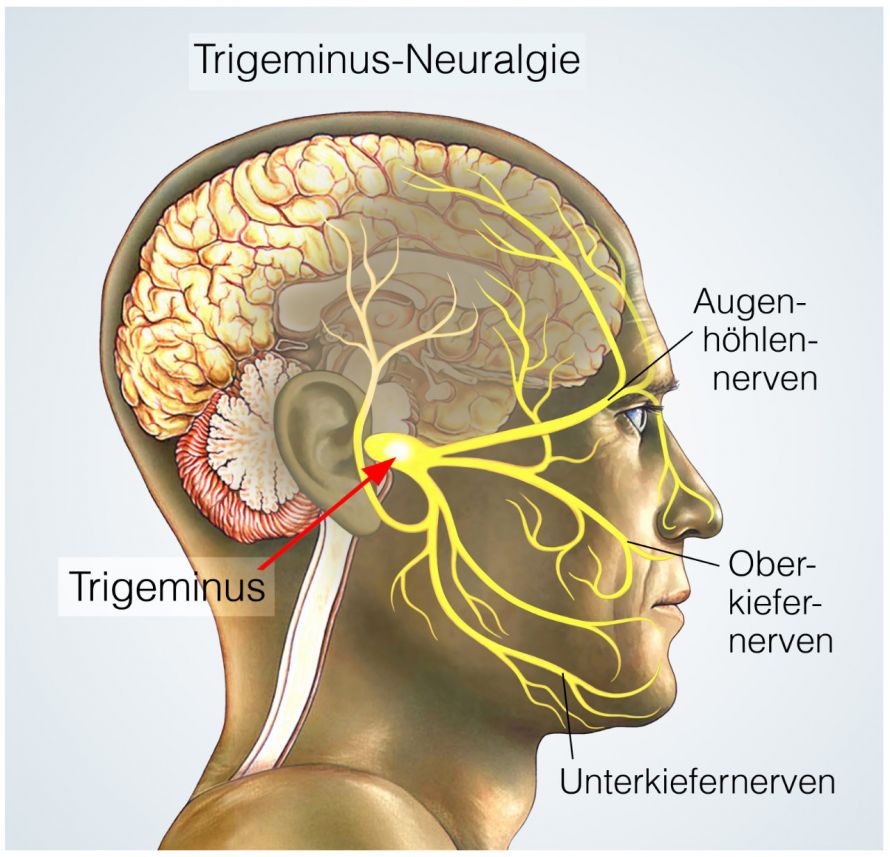 Trigeminusneuralgie
