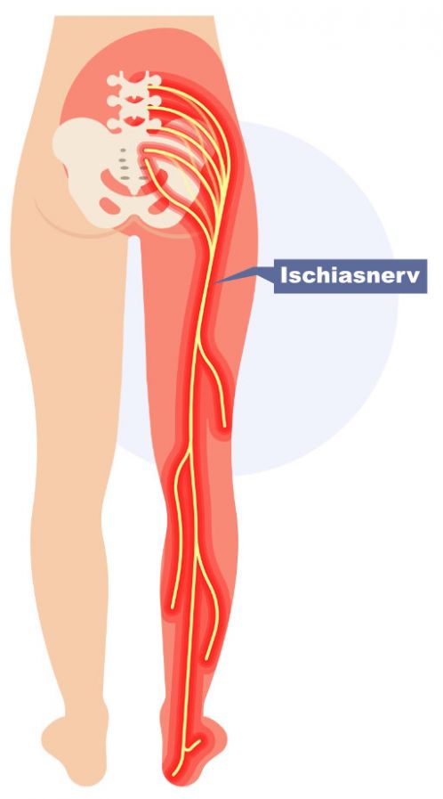Ischias-Schmerzen bei Rückenproblemen