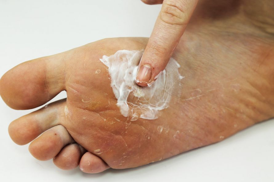 Topische Fußpilzbehandlung mittels Salbe