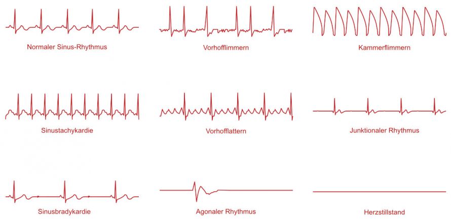 EKG-Linien und Bezeichnungen der verschiedenen Herzrhythmen