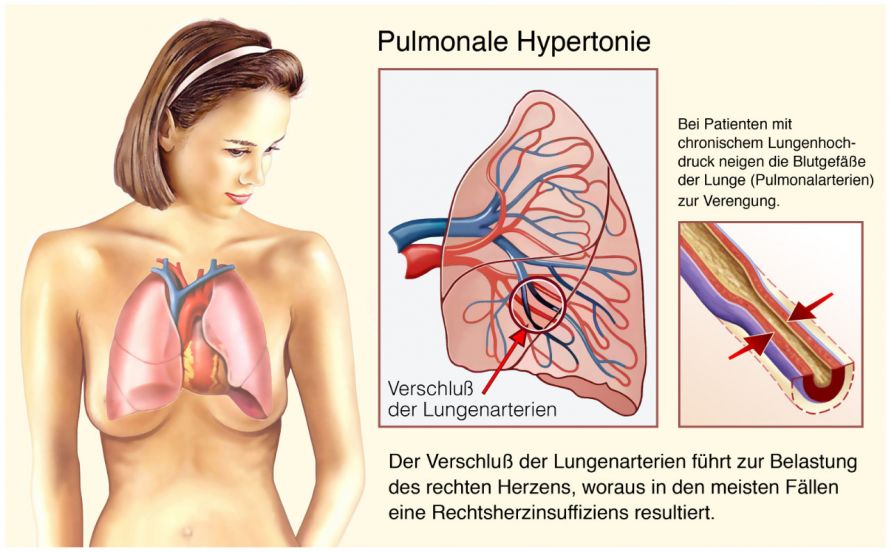 Pulmonale Hypertonie