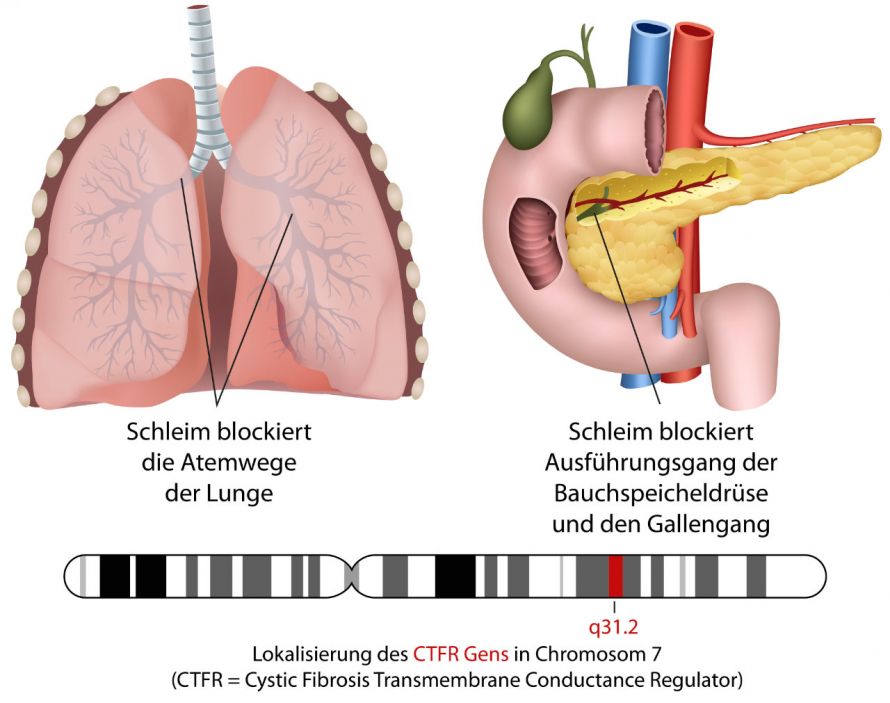 Die Auswirkung von Mukoviszidose auf die Lunge und Gallenwege