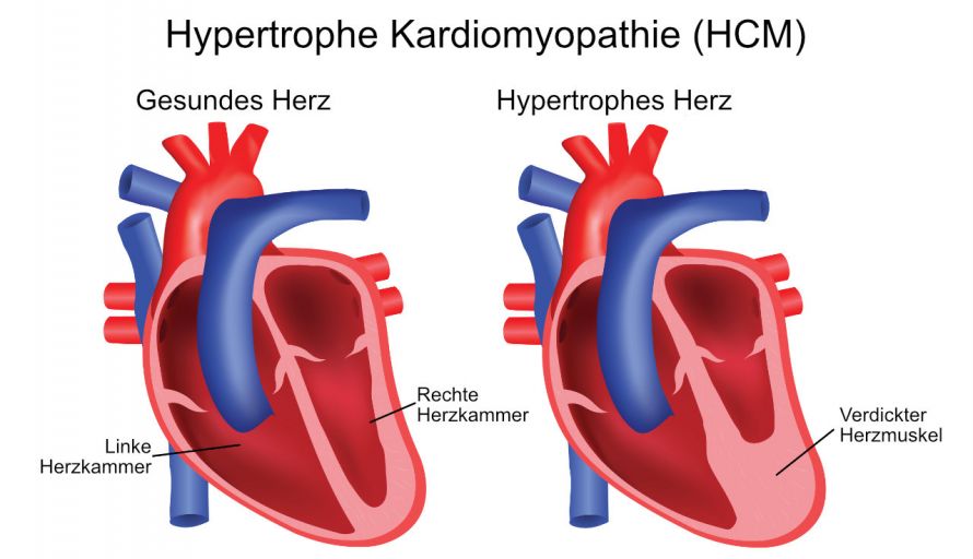Hypertrophe Kardiomyopathie