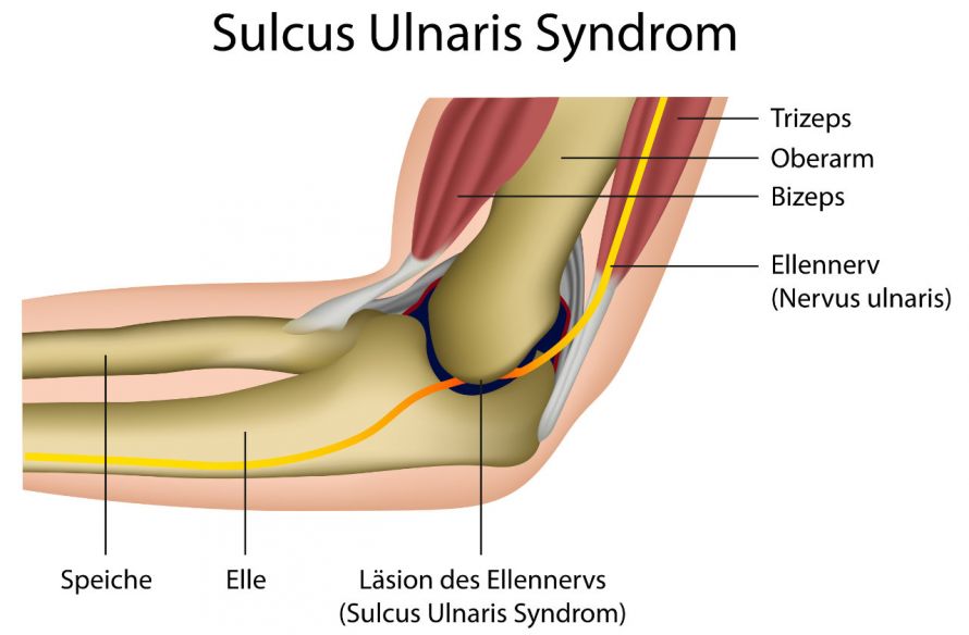 Sulcus Ulnaris-Syndrom am Ellenbogen