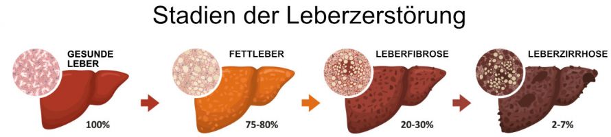 Fettleber - Leberfibrose - Leberzirrhose