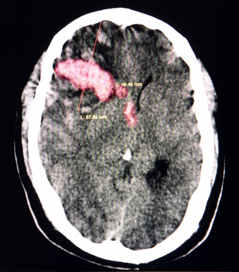 Hirnblutung im CT