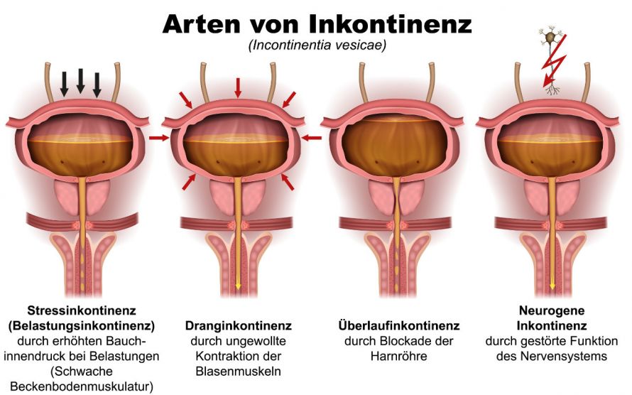 Verschiedene Formen von Harninkontinenz