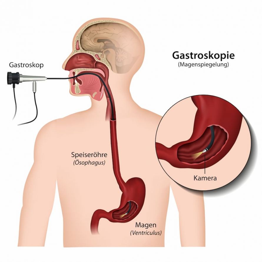 Abbildung Gastroskopie