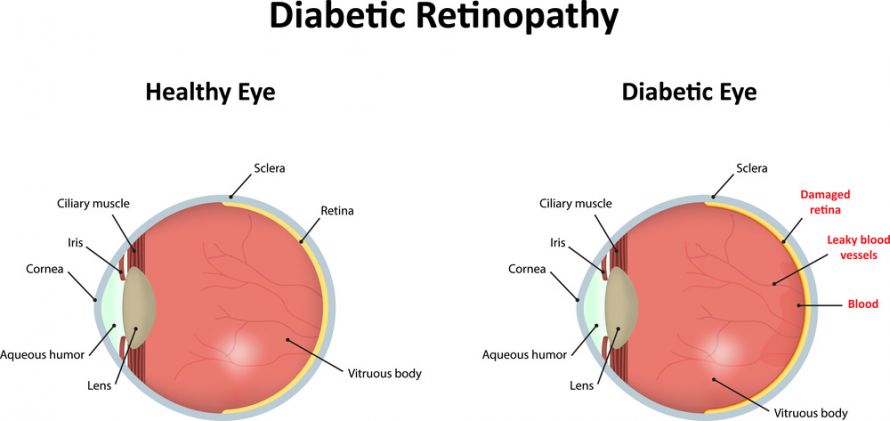 Vergleich gesundes Auge und Auge mit diabetischer Retinopathie