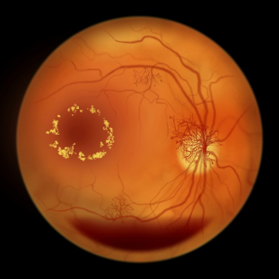 Auge mit Diabetischer Retinopathie nach Augenspiegelung