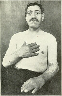 Male acromegaly patient (1904)