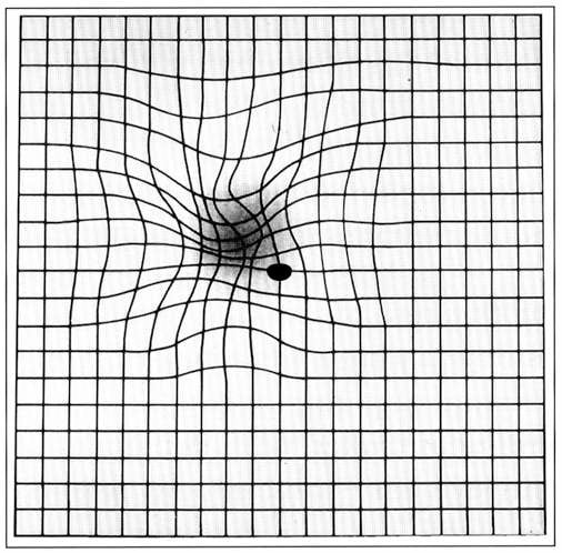 Amsler-Gitter mit Makuladegeneration