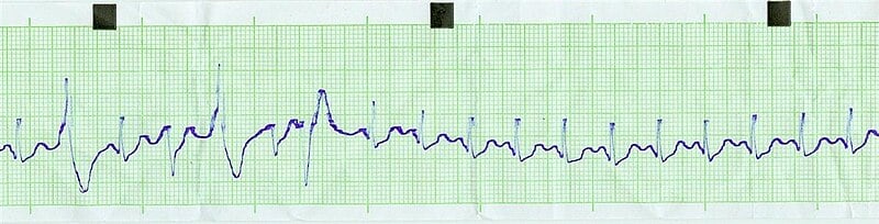 Ekg es tach bionerd.jpg