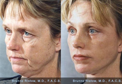 Face Lift 01 Dr. Ristow